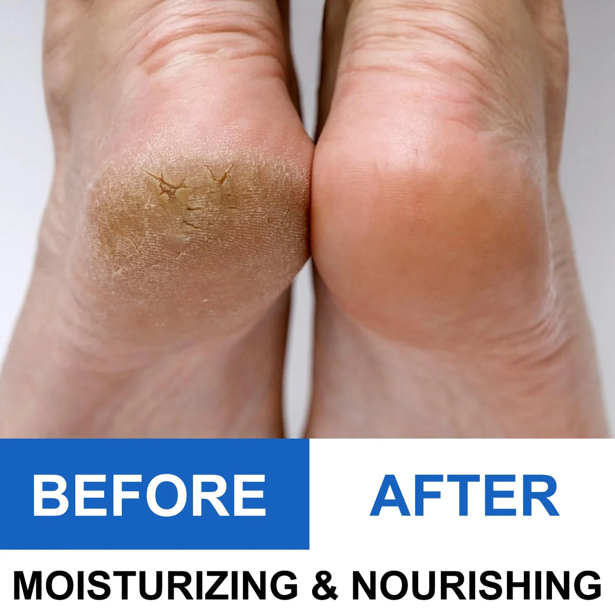 Cracked Heel Repair Stick — Fast Relief for Dry, Painful Heels – The ...